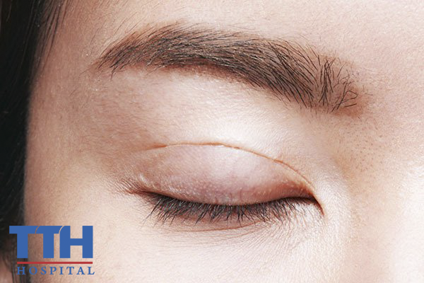 Lấy mỡ, da thừa mí mắt